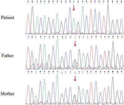 Case Report: A Case of β-Ureidopropionase Deficiency Complicated With MELAS Syndrome Caused by UPB1 Variant and Mitochondrial Gene Variant